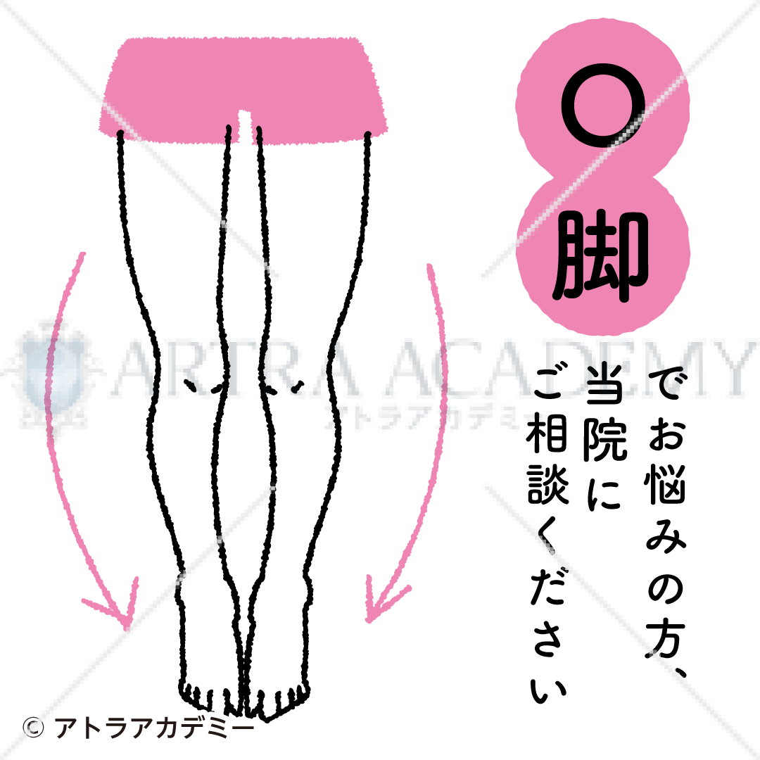 悩み〈O脚〉