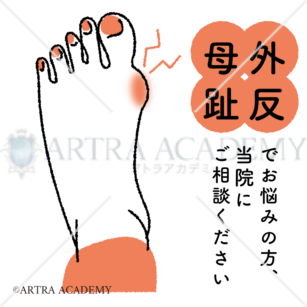 悩み〈外反母趾〉