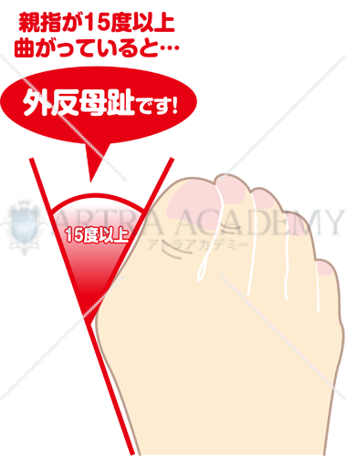 外反母趾の親指の角度