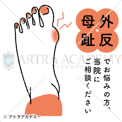 悩み〈外反母趾〉
