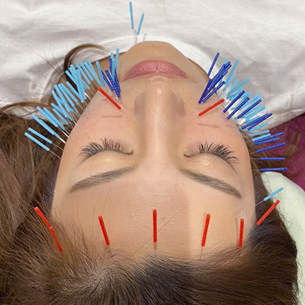 美容マロン鍼施術の様子