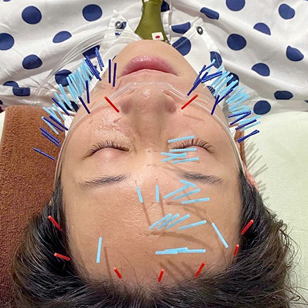 美容マロン鍼施術の様子