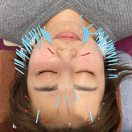 美容マロン鍼施術の様子