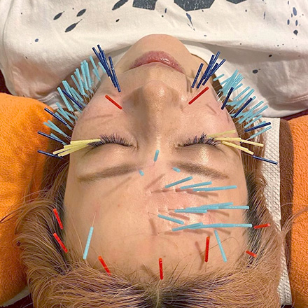 美容マロン鍼施術の様子