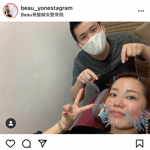 美容マロン鍼 施術イメージ